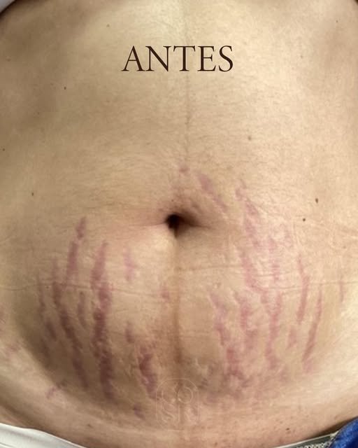 Antes del tratamiento de estrías en abdomen