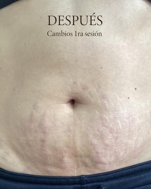 Después del tratamiento de estrías en abdomen