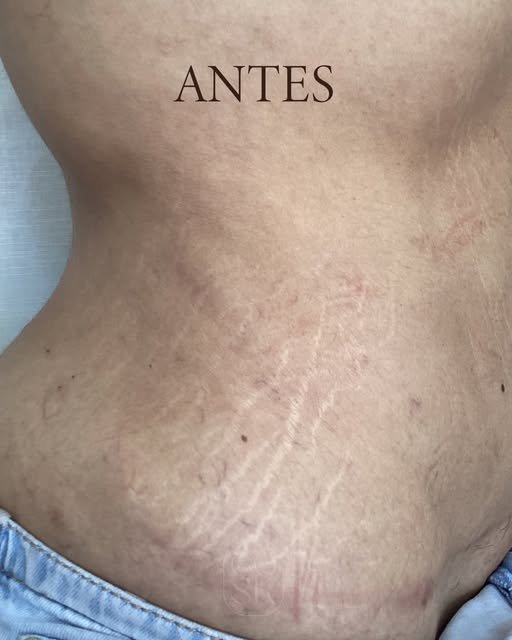 Antes del tratamiento de estrías en cintura