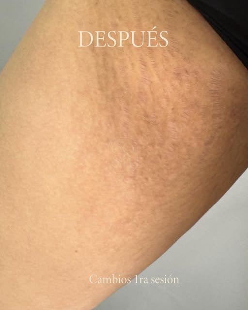 Después del tratamiento de estrías en entrepierna