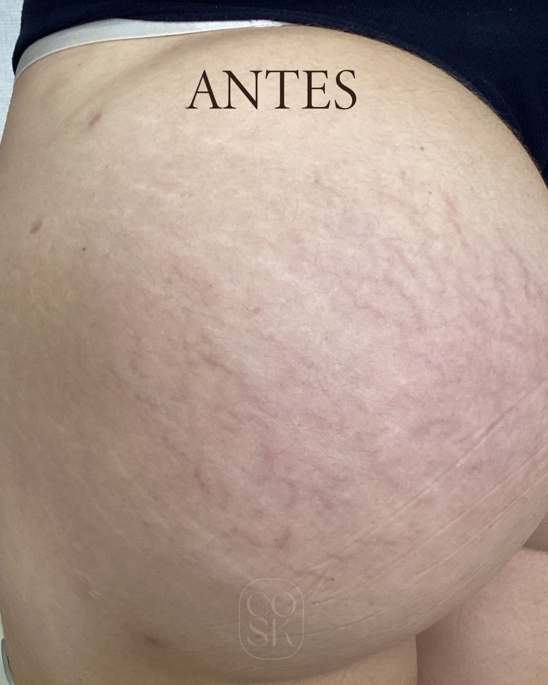 Antes del tratamiento de estrías en glúteos