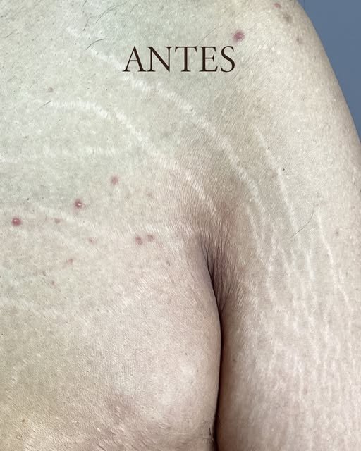 Antes del tratamiento de estrías en pecho