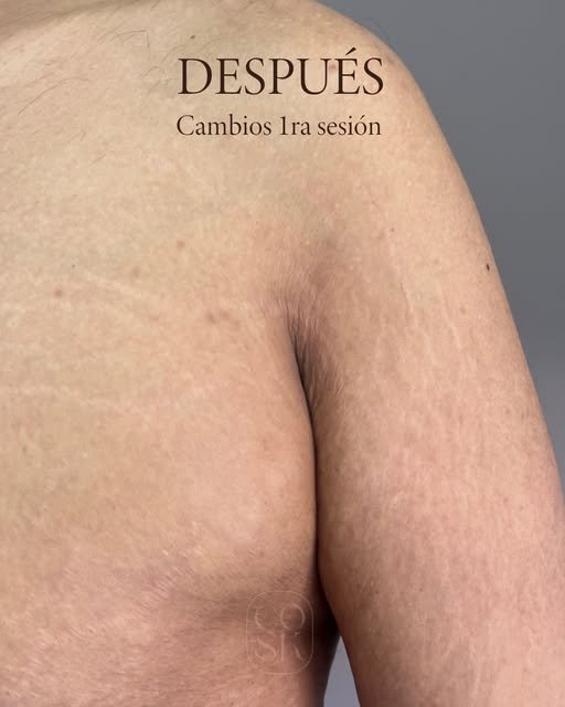Después del tratamiento de estrías en pecho