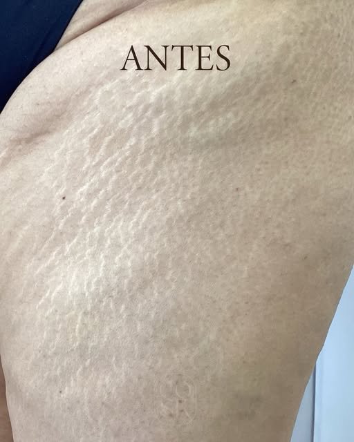 Antes del tratamiento de estrías en pierna