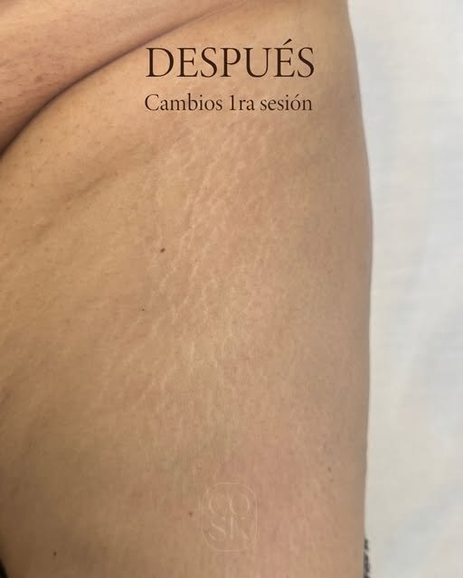 Después del tratamiento de estrías en pierna